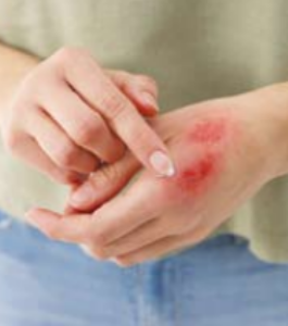 त्वचा भाजते किंवा जळते तेव्हा...